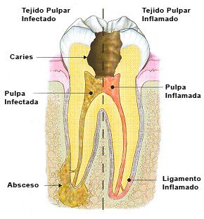 Introducción A La Endodoncia | Visión Moderna De La Endodoncia