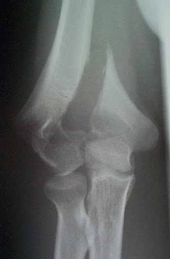 humerus bone anatomy. Intra-articular distal humeral