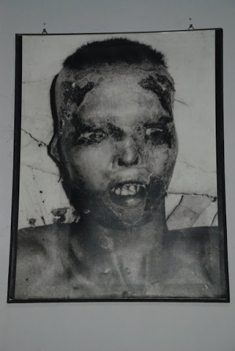 Side effects of Agent Orange