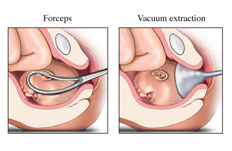 [forceps[4].jpg]