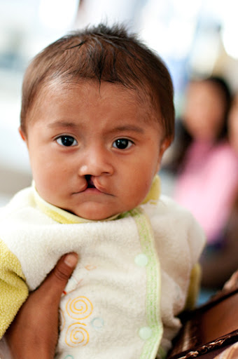 cleft lip before and after. 1 cleft lip and 2 cleft