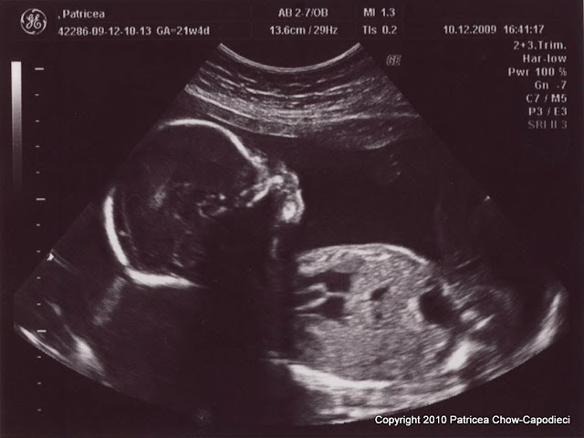 Week 22 Day 5 ultrasound