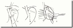 Rassegne di scleroterapia delle estremità più basse