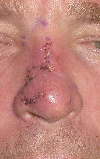 Bilobed flap reconstruction of the nose front view