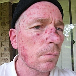 Facial skin reaction after two weeks of Aldara skin cancer treatment - right side of face image