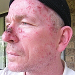 Facial skin reaction after two weeks of Aldara skin cancer treatment - left side of face image