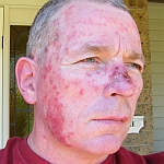 Aldara treatment reaction to right side of face