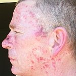 Aldara treatment reaction to left side of face