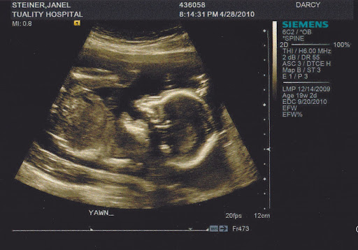 are 4d ultrasounds harmfull to unborn babies