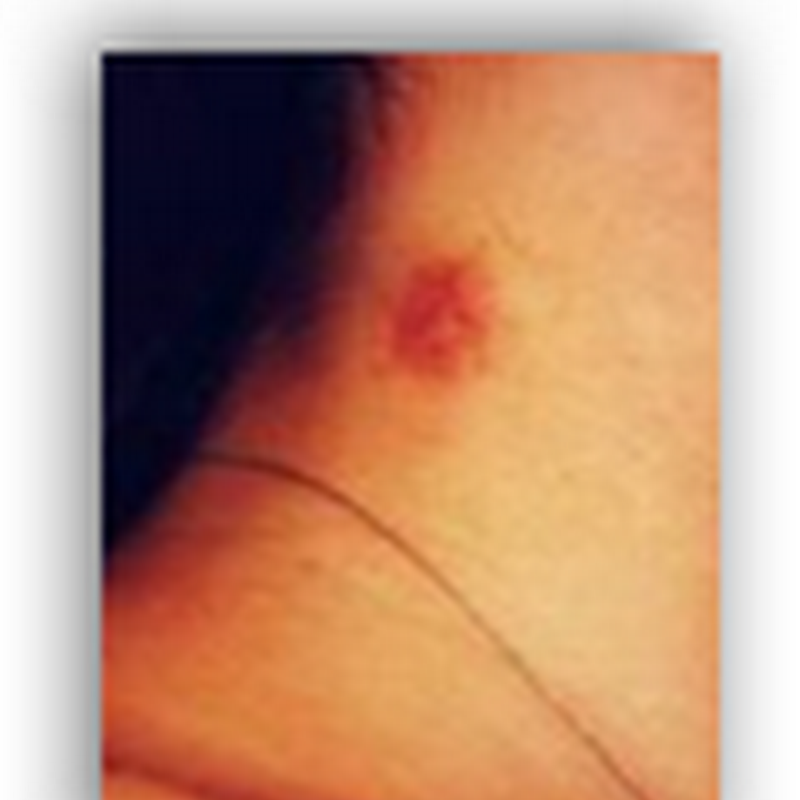 Hickey Partially Paralyzes Woman in New Zealand