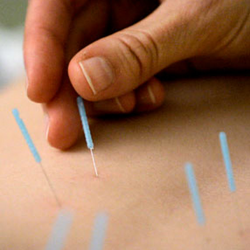 La ciencia avala el uso de la acupuntura: la medicina oficial integra la técnica de las agujas como terapia.