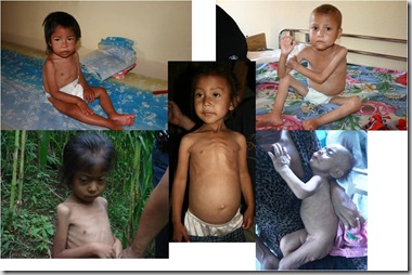 malnutrition_cases_