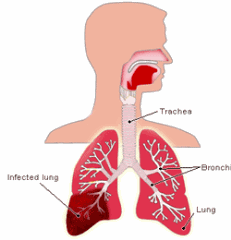 pneumonia