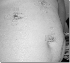 b&w stomach after appendectomy