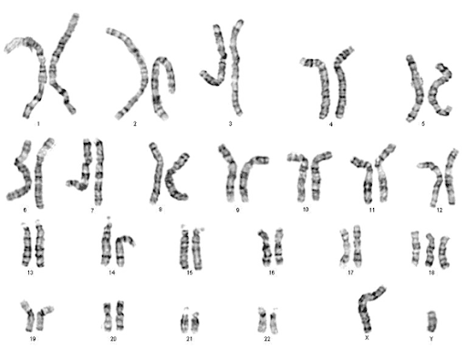 trisomi