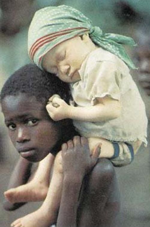 albino people