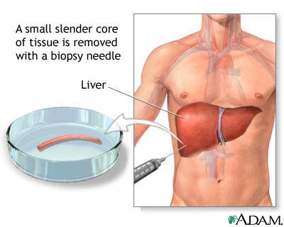 liver-biopsy liver-biopsy