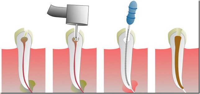 Root_Canal_Illustration