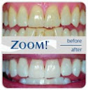 laser teeth whitening