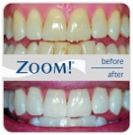 zoom teeth whitening system
