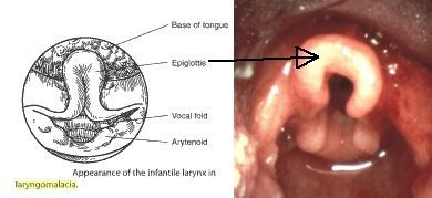 omega epiglottis