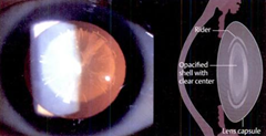 lamellar cataract