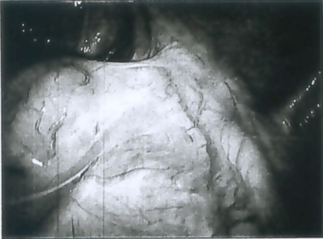 [laparoscopy01B[1].jpg]