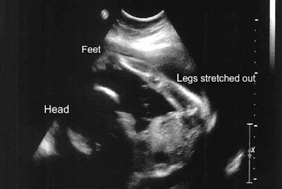 Ultrasound