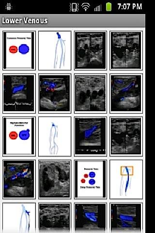 【免費醫療App】iSonographer Venous R/O DVT-APP點子