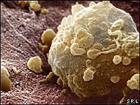 [_44947655_080821melanoma203b[12].jpg]