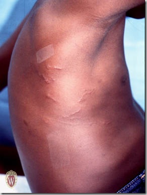Enlarged Sebaceous Glands