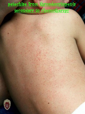 [petechiae[3].jpg]