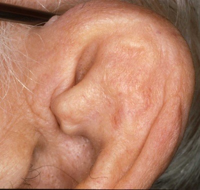 [cauliflower ear[2].jpg]