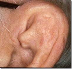 cauliflower ear