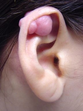 [Keloid_2[2].jpg]