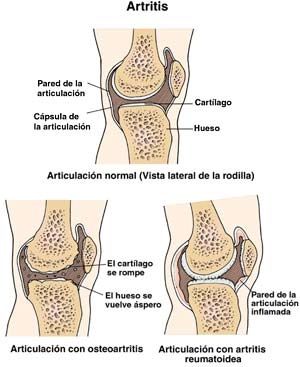 ArtritisVSD