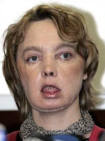 Isabelle_Dinoire_First_Partial_Face_Transplant.jpg