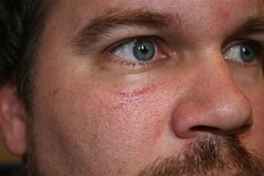 scar close up