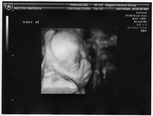 Baby A