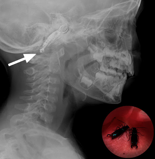 Earwig Listening Device