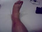 Something is very wrong with my leg, and I don't know what - except I'm pretty sure it isn't supposed to be that shape or colour..