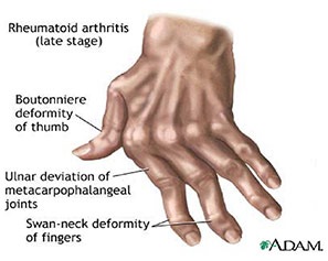 [rheumatoid_arthritis_pic[2].jpg]
