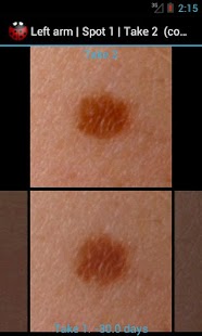 How to get Skin Monitor: check your moles 1.3.2 apk for laptop