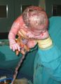 Umbilical Cord blood