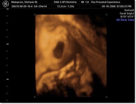 emilyultrasound 030