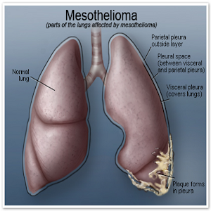 What Is Mesothelioma?.apk 1.0