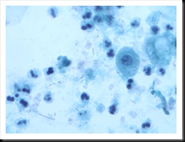 urinary tract infection