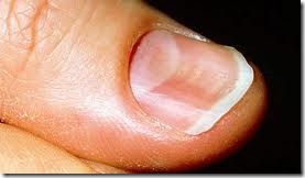 Spoon shaped nails in iron deficiency anemia