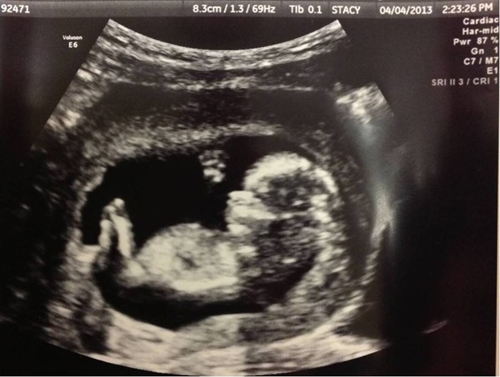 baby 12 weeks ultrasound 2