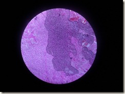 osteosarcoma histology slide